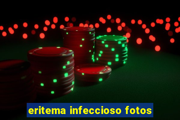 eritema infeccioso fotos